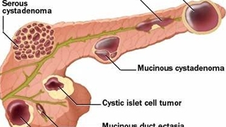 Giúp bạn Bệnh u nang tuyến tụy