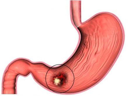 Giúp bạn Bệnh viêm dạ dày