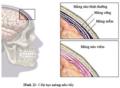 Giúp bạn Bệnh viêm màng não