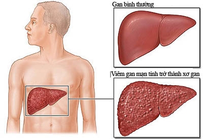 Giúp bạn Bệnh xơ gan