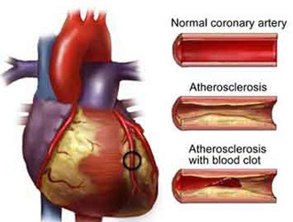 Giúp bạn Bệnh xơ vữa động mạch