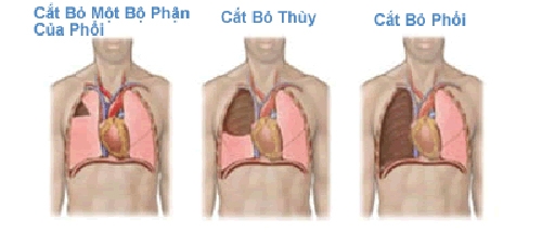 Giúp bạn Biến chứng và tiên lượng sau phẫu thuật cắt bỏ phổi