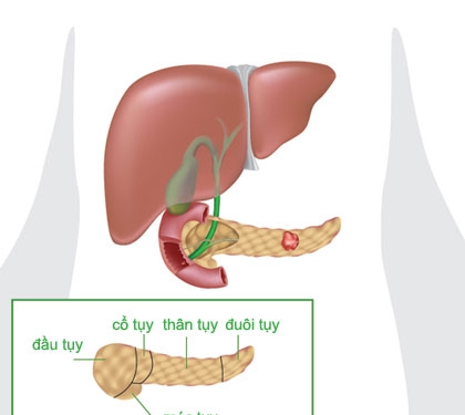 Giúp bạn Chẩn đoán và điều trị u nang tuyến tụy