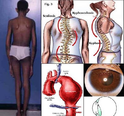 Giúp bạn Hội chứng Marfan: Nguyên nhân và triệu chứng bệnh