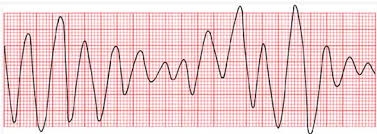 Giúp bạn Hội chứng QT kéo dài: Biến chứng và phòng ngừa bệnh