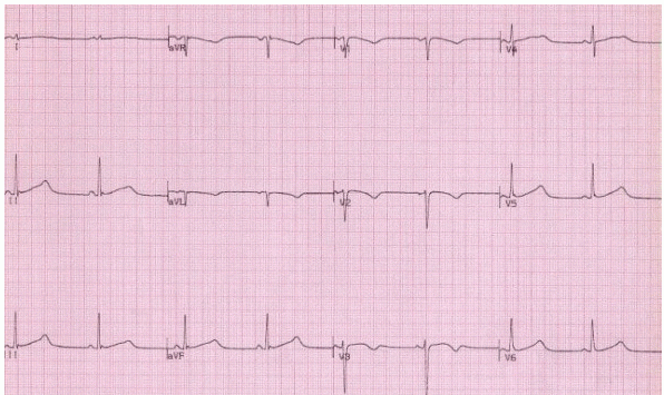 Giúp bạn Hội chứng QT kéo dài: Nguyên nhân gây bệnh