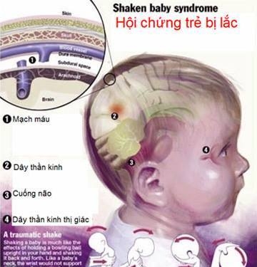 Giúp bạn Hội chứng rung lắc: Đừng để dỗ con thành hại con