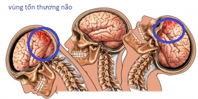 Giúp bạn Hội chứng rung lắc ở trẻ em