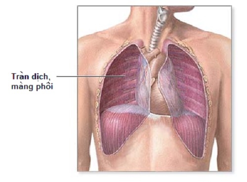 Giúp bạn Hội chứng tràn dịch màng phổi