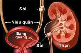 Giúp bạn Làm sao để sỏi thận không tái phát?