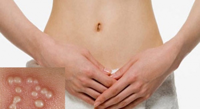 Giúp bạn Làm sao khi bị nhiễm vi-rút Herpes?