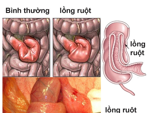 Giúp bạn Lồng ruột: Chẩn đoán, điều trị