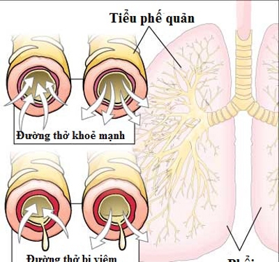 Giúp bạn Ngừa hen phế quản ở thai phụ 