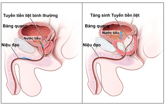 Giúp bạn Nguyên nhân gây viêm tuyến tiền liệt