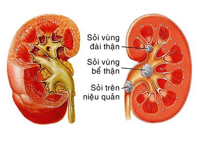 Giúp bạn Nguyên nhân, triệu chứng của bệnh sỏi thận