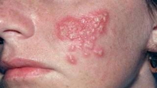 Giúp bạn Nhiễm herpes simplex