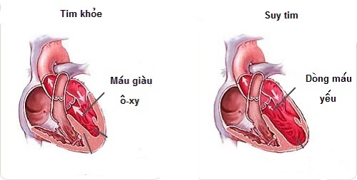 Giúp bạn Những điều cần biết về suy tim