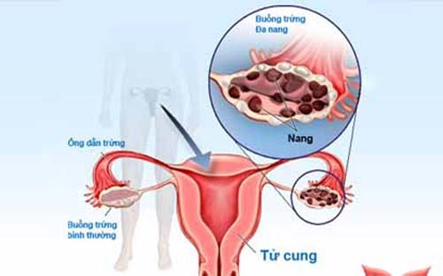 Giúp bạn Những điều chưa biết về hội chứng buồng trứng đa nang