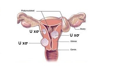 Giúp bạn Những thắc mắc thường gặp về bệnh u xơ tử cung