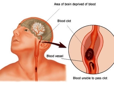 Giúp bạn Những triệu chứng khó nhận biết của bệnh vữa xơ động mạch cảnh