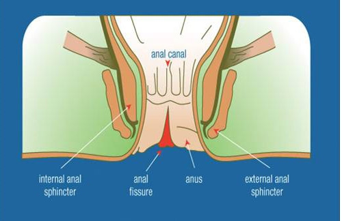 Giúp bạn Nứt kẽ hậu môn: Chẩn đoán, biến chứng