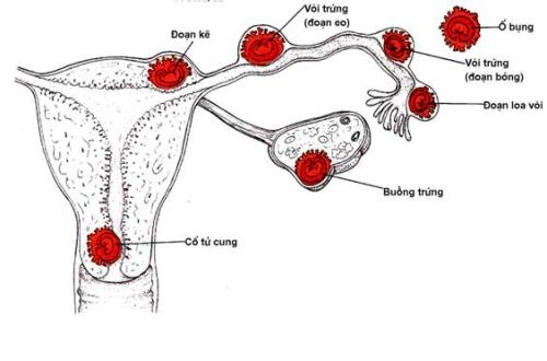 Giúp bạn Phòng ngừa biến chứng thai ngoài tử cung