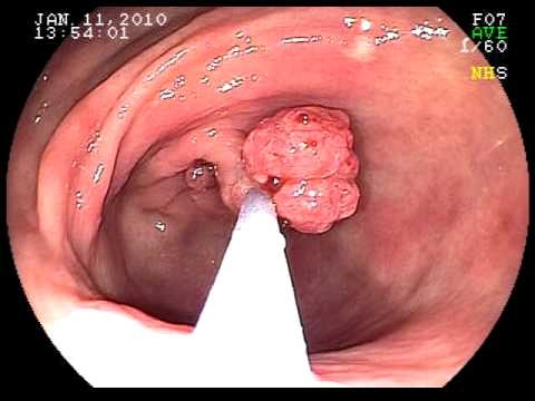 Giúp bạn Polyp dạ dày