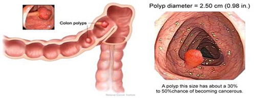 Giúp bạn Polyp trực tràng: Nguyên nhân, triệu chứng