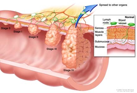 Giúp bạn Polyp trực tràng: Phòng ngừa, điều trị