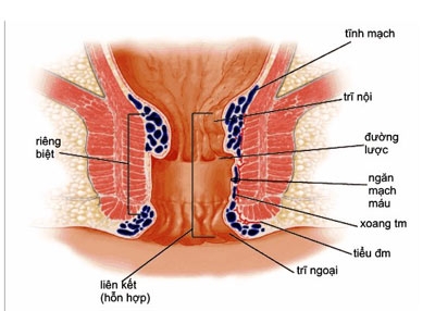 Giúp bạn Sa trực tràng: Nguyên nhân, triệu chứng