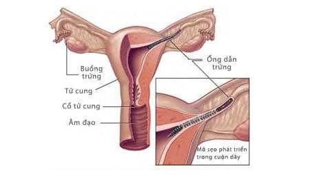 Giúp bạn Tắc 1 bên vòi trứng có bị vô sinh?