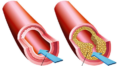 Giúp bạn Tác dụng phụ khi dùng thuốc điều trị rối loạn lipid máu