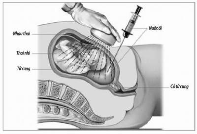 Giúp bạn Tắc mạch ối