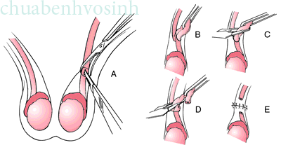 Giúp bạn Thắt ống dẫn tinh liệu có thể sinh con?