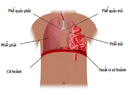 Giúp bạn Thoát vị hoành: Biến chứng, chế độ chăm sóc