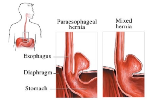 Giúp bạn Thoát vị hoành: Phòng ngừa, điều trị