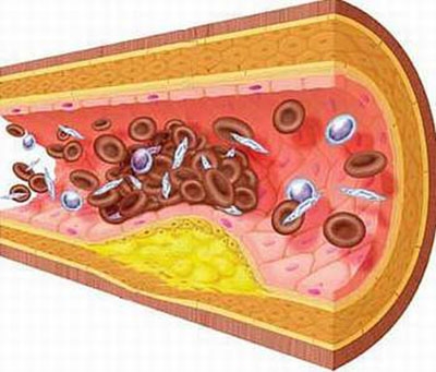 Giúp bạn Thuốc điều trị bệnh máu nhiễm mỡ