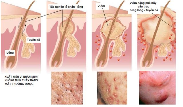 Giúp bạn Tìm hiểu về mụn trứng cá (P.1)