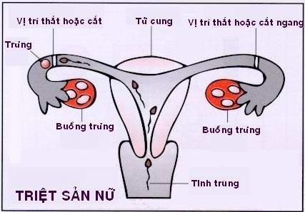 Giúp bạn Triệt sản nữ: Những điều cần biết