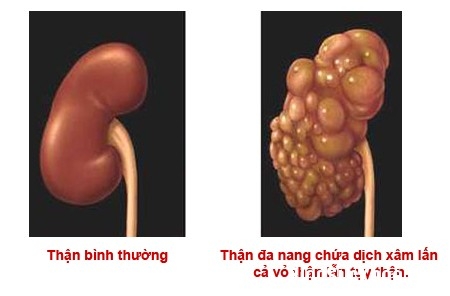 Giúp bạn Triệu chứng bệnh thận đa nang