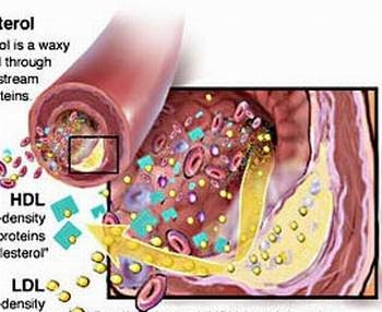 Giúp bạn Triệu chứng, nguyên nhân của bệnh rối loạn mỡ máu