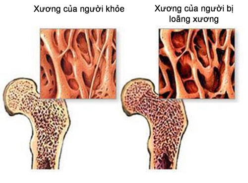 Giúp bạn Triệu chứng thiếu canxi