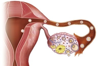 Giúp bạn Ung thư buồng trứng