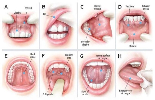 Giúp bạn Ung thư khoang miệng