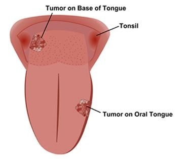 Giúp bạn Ung thư lưỡi