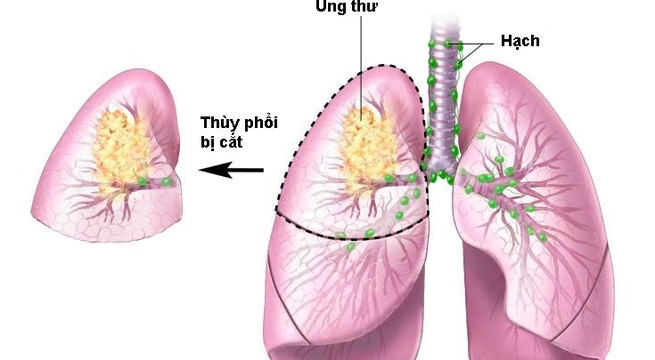 Giúp bạn Ung thư phổi có thể tồn tại trong cơ thể 20 năm trước khi phát bệnh