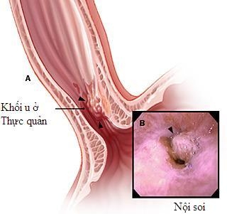 Giúp bạn Ung thư thực quản