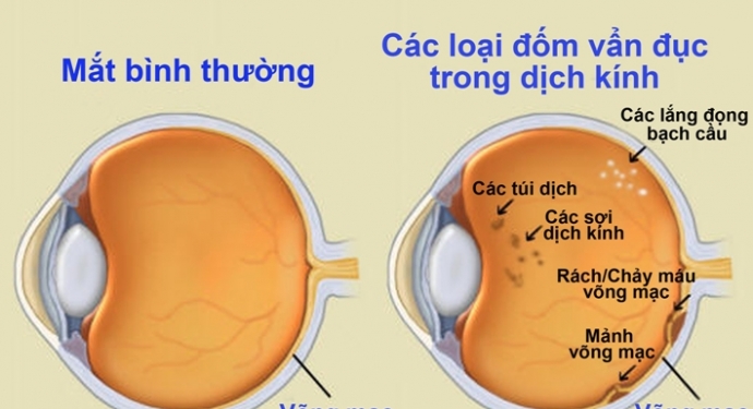 Giúp bạn Vẩn đục dịch kính