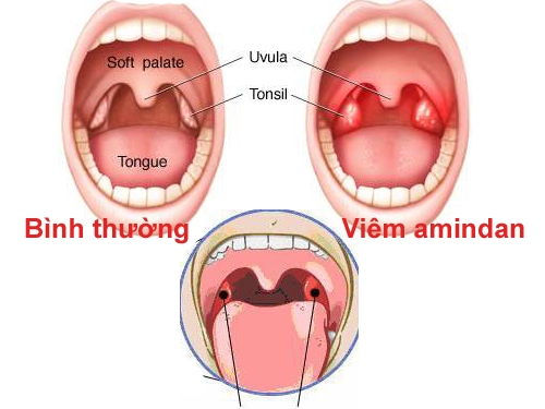 Giúp bạn Viêm amidan