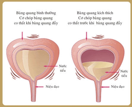 Giúp bạn Viêm bàng quang